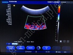 SIEMENS Ultrasound Color Doppler