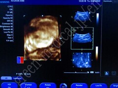 SIEMENS Ultrasound Color Doppler